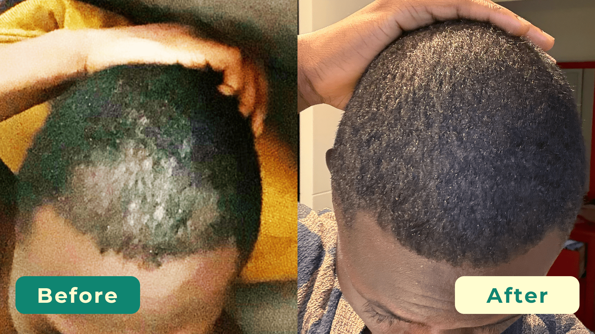 Follicle Reviver Natural DHT Blocker - Scalpsculpt